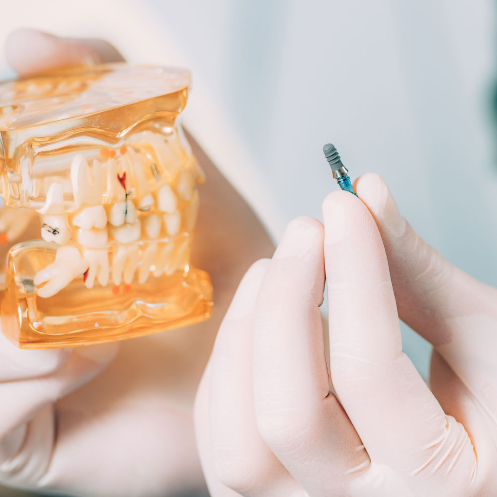 IMPLANTOLOGIA CONVENZIONALE dentista segrate milano
